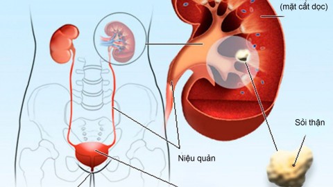 Chuối "dũng sĩ" phòng chống bệnh sỏi thận